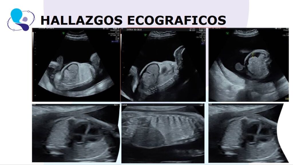 CHAOS CASO CLINICO MEDICINA MATERNO FETAL ARGENTINA3