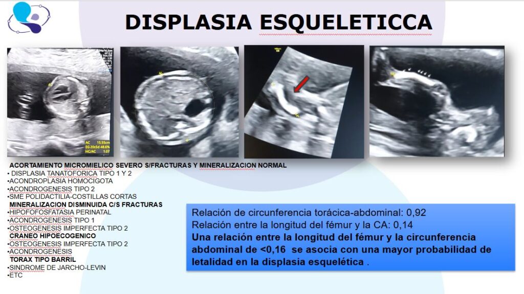 Dispalsia esqueleticia medicina materno fetal argentina2