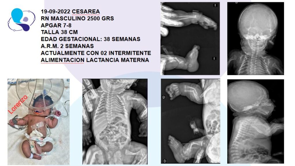 Dispalsia esqueleticia medicina materno fetal argentina6