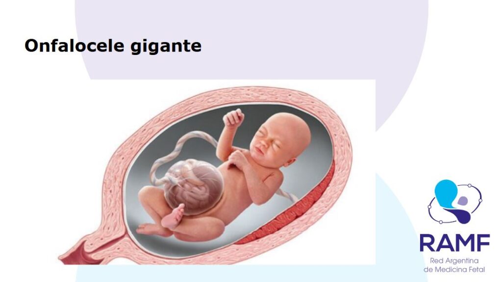 Onfalocele gigante