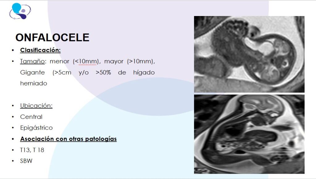 Onfalocele gigante11