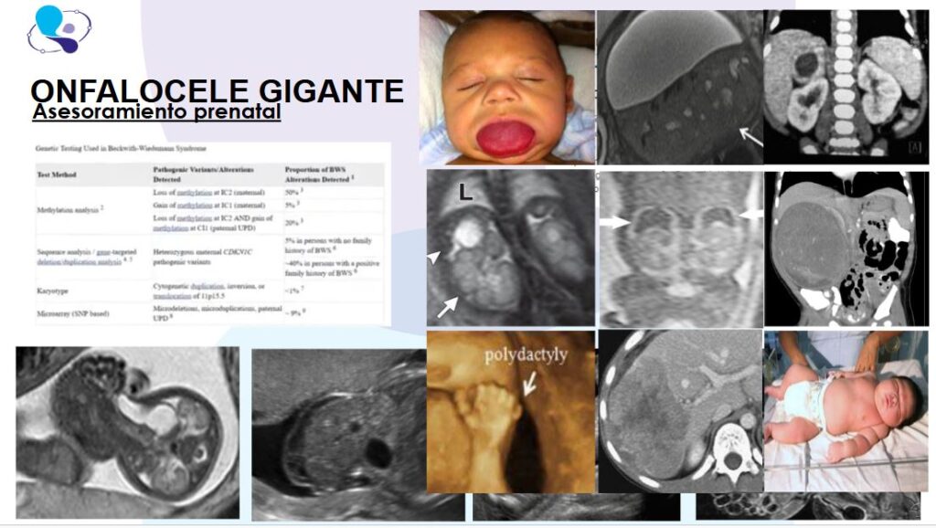 Onfalocele gigante15